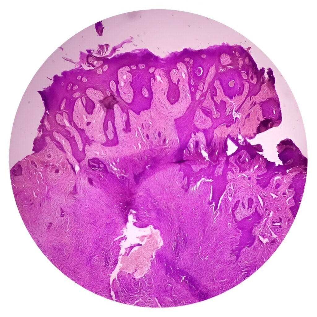 Skin cancer cells under microscope I Phillip E Miles