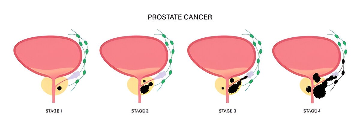Prostate cancer stages I Phillip E Miles