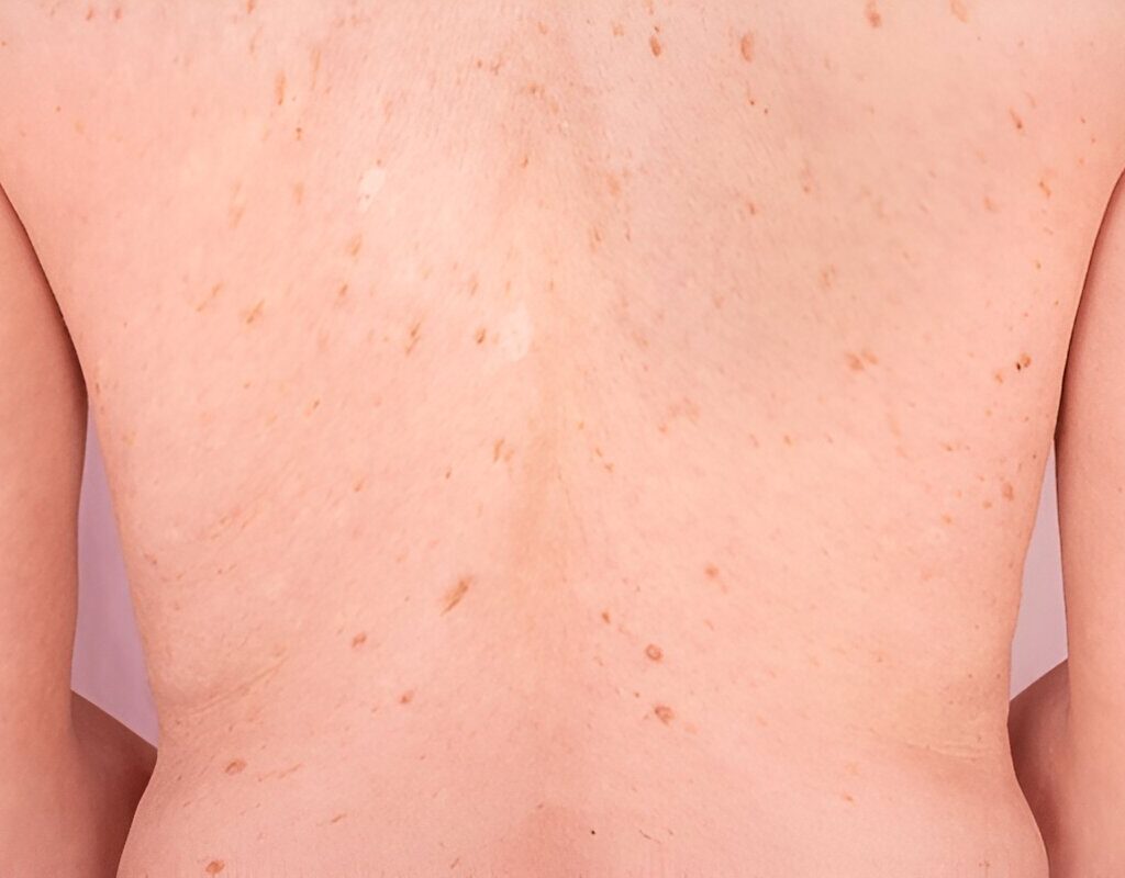 Skin Cancer screening test in US_Curepoint Cancer Center