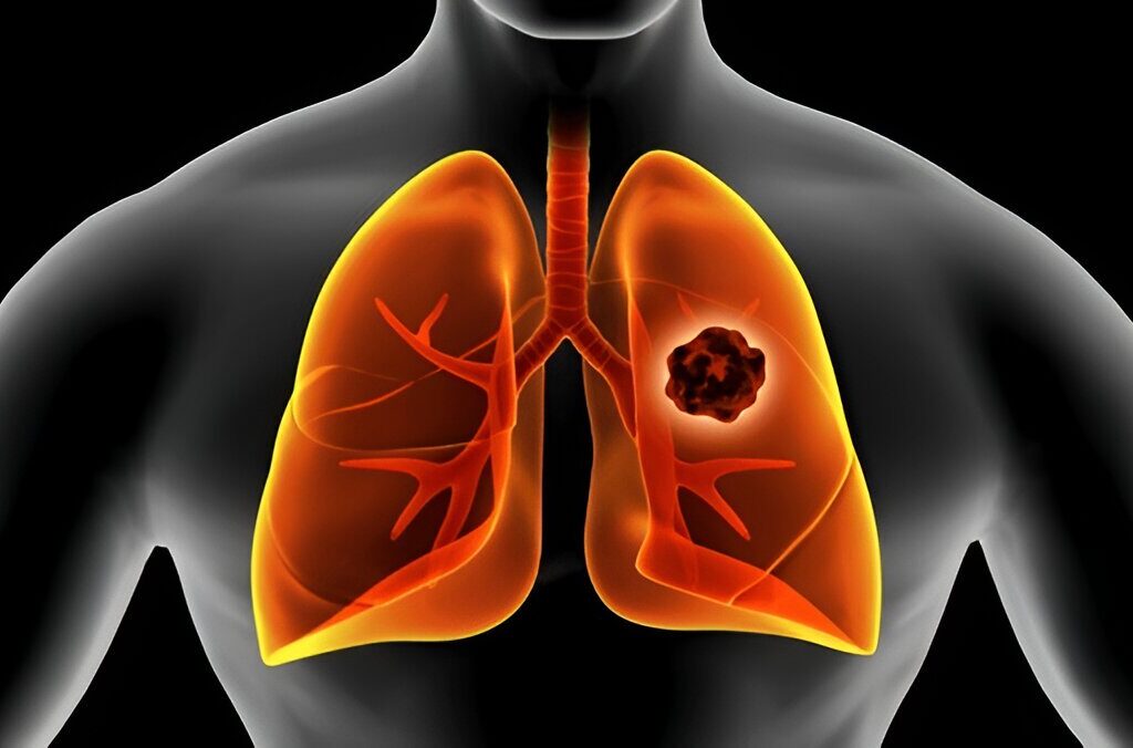 lung cancer