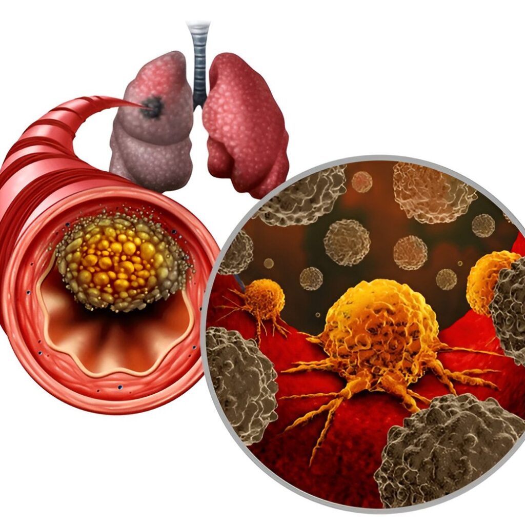 Lung Cancer Treatment by CurePoint Cancer Center in Georgia