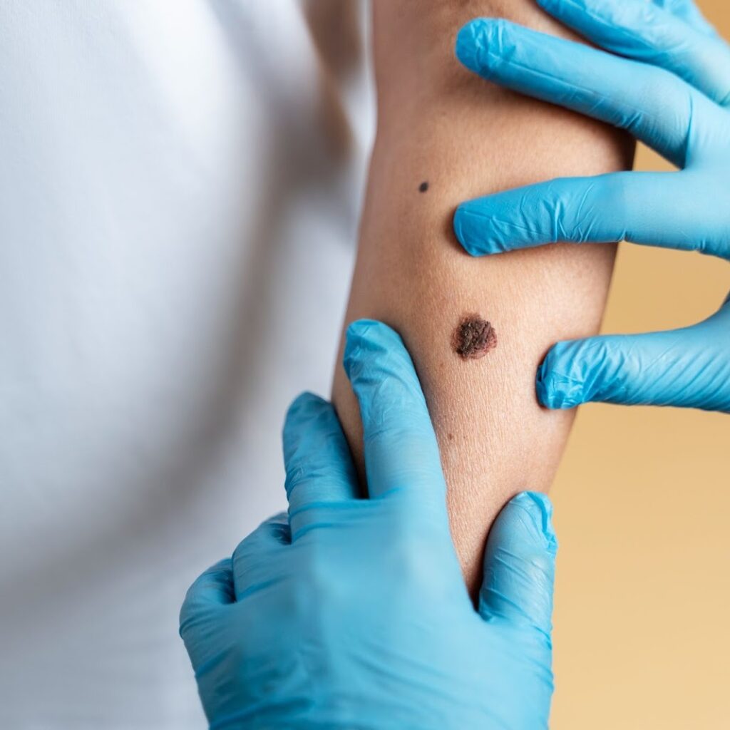 skin cancer treatment in Georgia